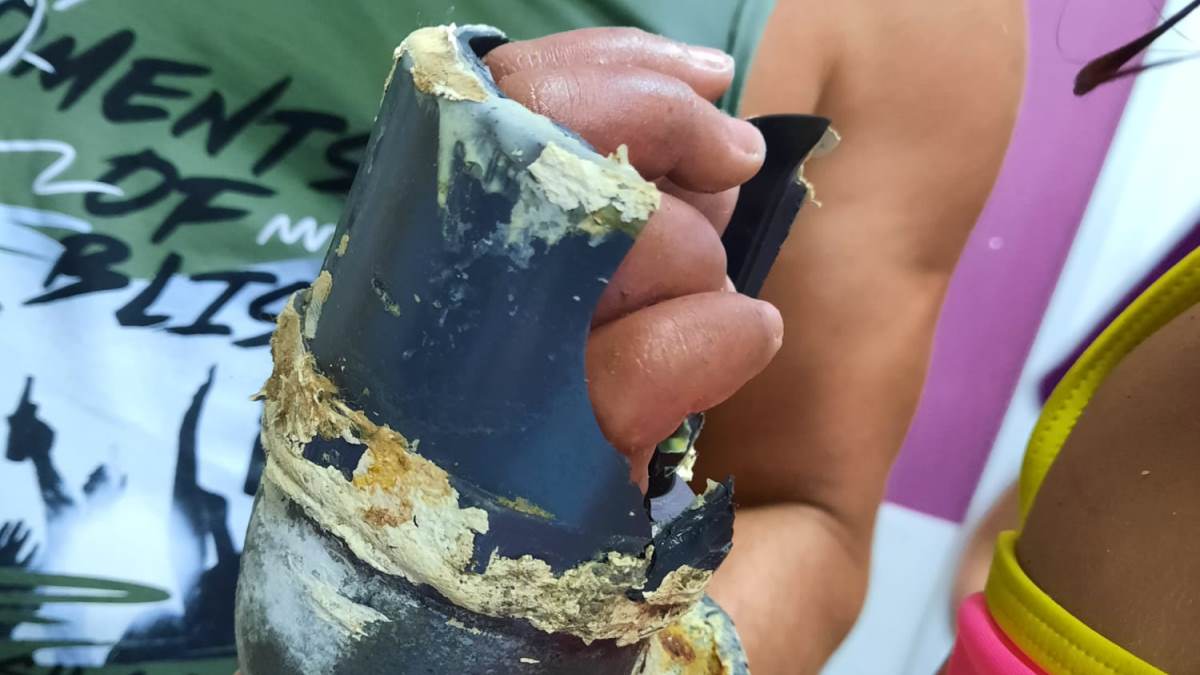 Mâna unei fetițe de 5 ani, prinsă în tubul de absorție al unei piscine din Mamaia. Ea a fost anesteziată la spital pentru îndepărtarea tubului respectiv